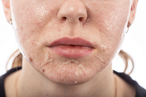 Các vấn đề thường gặp khi peel da và cách xử lý